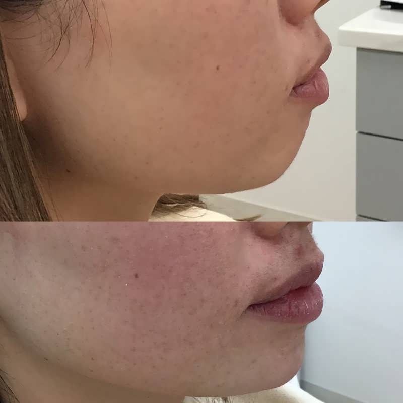Improvement of Melasma with Medical grade products