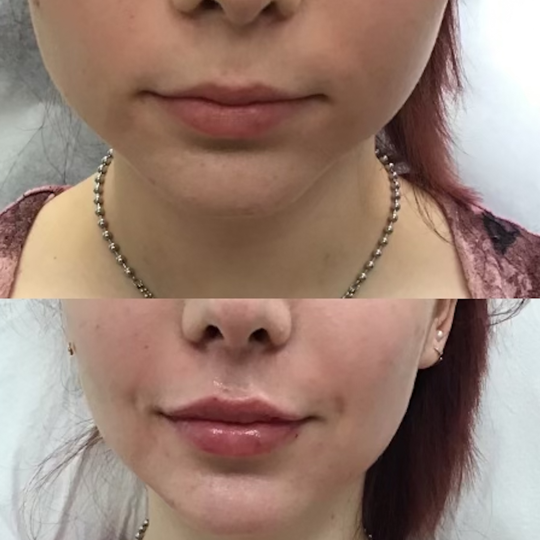 Lip augmentation with Restylane