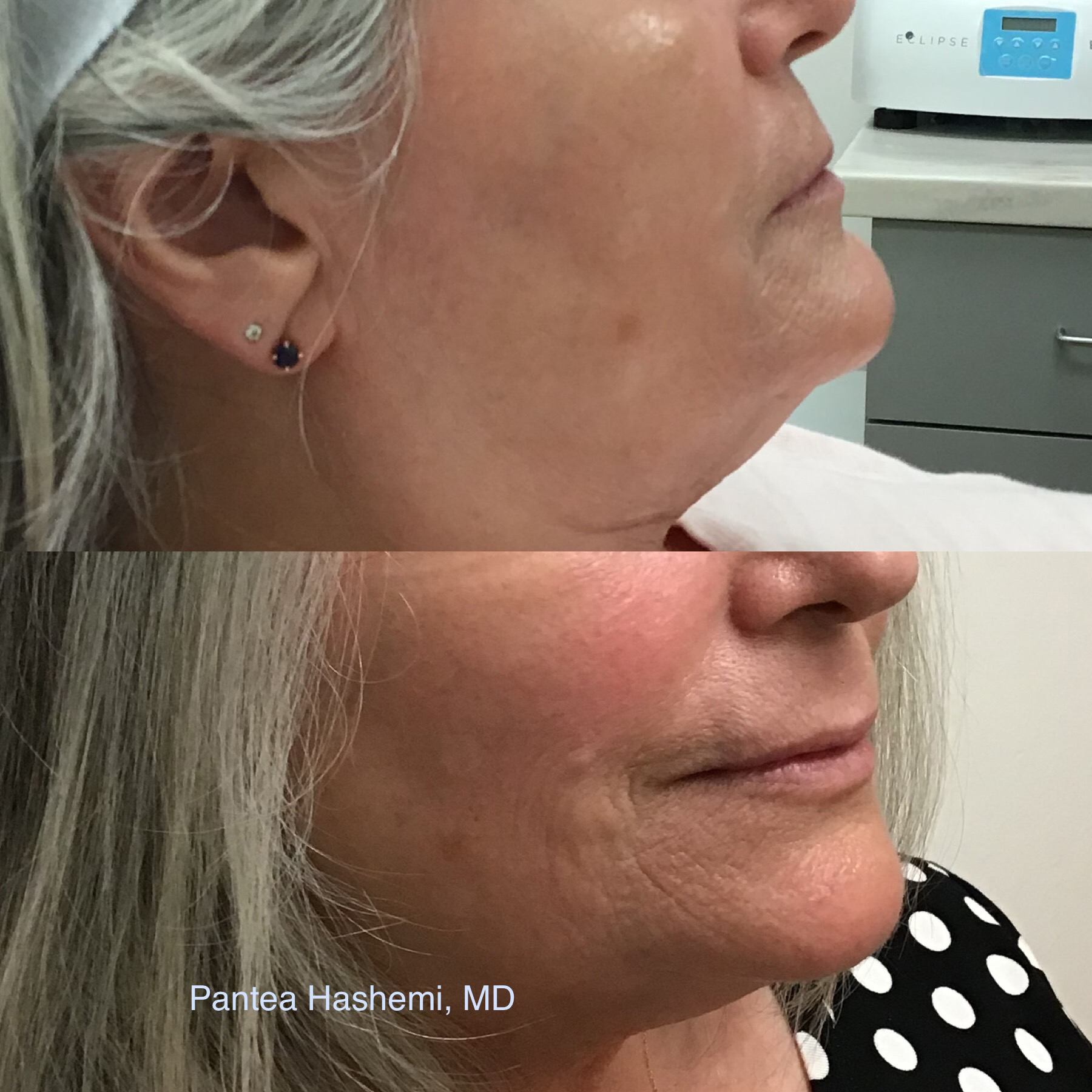 Lower face rejuvenation with RHA filler