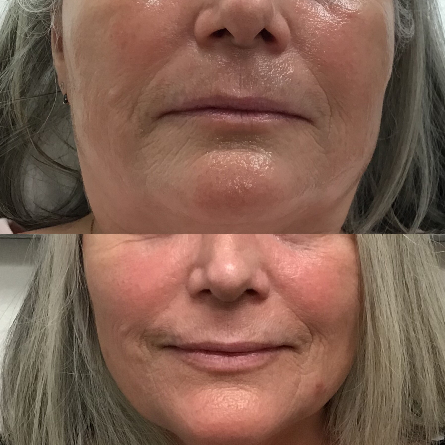 Lower face rejuvenation with filler 2