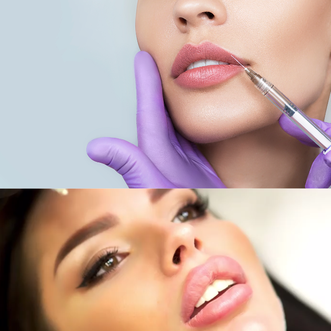 Lip Augmentation – What You Need To Know