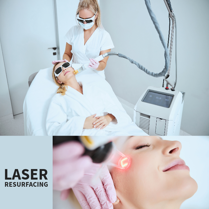 What is laser resurfacing?