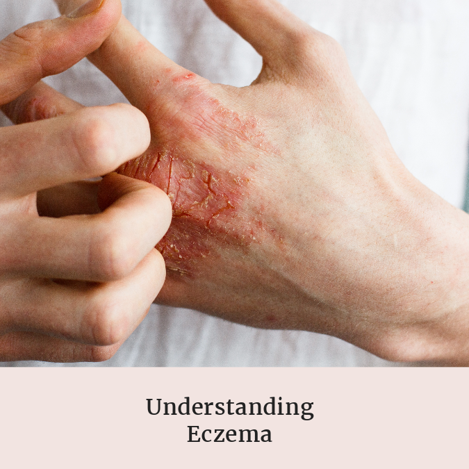 A Guide to Understanding Eczema: Triggers, Management, and Lifestyle Tips