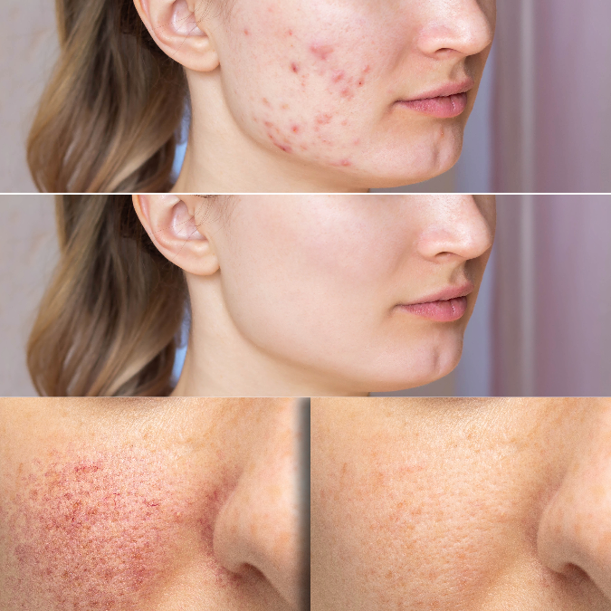The Science of Acne: Causes, Treatment Options, and Preventive Measures